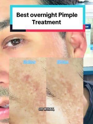 Whether is inconsistent ZZZ’s 🥱 or stress from work, this can sometimes trigger breakouts. Two ingredients I’ve always counted on for healing pimples rapidly overnight: -Salicylic acid -Sulfur Sulfur promoted healing and calming inflammation while salicylic acid unclogs pores and dries out the pimple. It is so relieving when you address your pimples and the fade pretty much overnight. #acne #acnescars #pimples #drleo #tiktokshopcreatorpicks