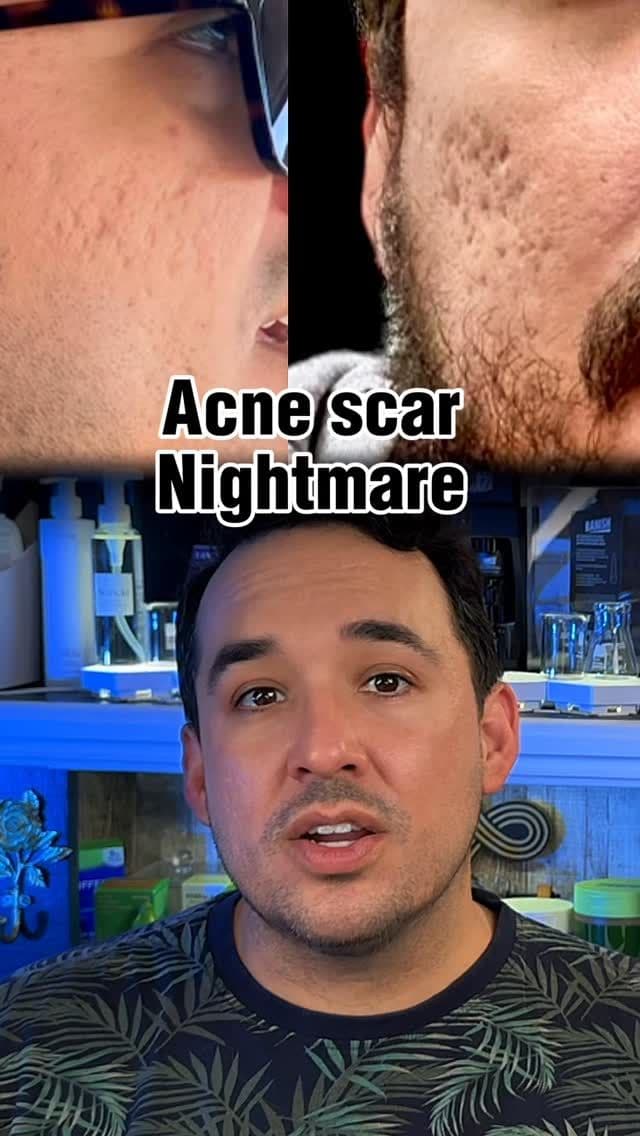 Use discount code HEALING through the link in my bio or shop https://banish.com/healing
❤️🩹
Home microneedling is not