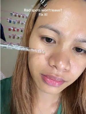 Red spots won’t leave? Fix it! #GoViralWithSKIN1004Challenge #SKIN1004White #skin1004 #centella #TikTokMadeMeBuyIt @skin1004_challenge @SKIN1004 US