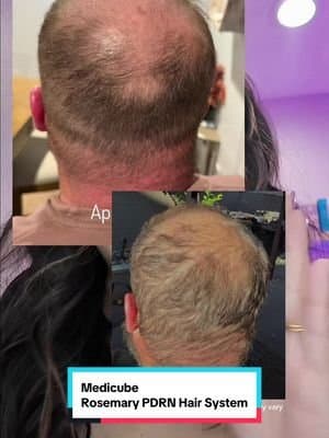 One month of consistent use with the @medicube global rosemary shampoo, conditioner, and scalp serum and my husband’s hair is visibly looking fuller, thicker, and growing back in spots that were thinning before. We were not expecting this much of a difference this fast. If you’ve been struggling with thinning hair, hair shedding, or scalp issues, this Korean haircare routine might actually be worth the hype. #tiktokshopmemorialday #thinninghair #kbeauty #hairregrowth #tiktokshopcreatorpicks