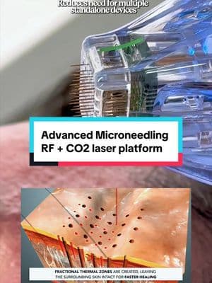 Combination energy matters in acne scar revision. Fractional CO₂ addresses surface irregularity. RF microneedling delivers thermal stimulation at depth. Different layers. Different mechanisms. One treatment plan. Secret PRO by Cutera combines fractional CO₂ resurfacing with radiofrequency microneedling to address both epidermal texture and deeper collagen remodeling. Layer-specific intervention matters in scar revision. My personal testimony and before and afters affirm the capabilities that would benefit both patients and providers. @Secret by Cutera @Cutera made in collaboration with Dr. House at @housemdplastics #AestheticMedicine #acnescars #aesthetics #FractionalLaser #microneedling