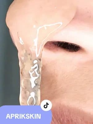 Blackheads, whiteheads and all dirt in my nose for two decades, ewwww😷🤮 Pore clean day. With @APRILSKIN USA @에이프릴스킨 APRILSKIN @aprilskin_tw_official Product used: 🍀 THE CALENDULA MASK ✨Infused with Salicylic Acid(BHA) and PHA, it gently exfoliates blackheads and dead skin cells Soothes irritation with real calendula flower extract. 🍀 TXA Niacinamide Toning Shot 99 Spicule Facial Serum. ✨Infused with 1.02M spicules coated with and containing 3% TXA & 5% niacinamide Liquid microneedling serum targetshyperpigmentation and boosts skin renewal. 🍀 TXA Niacinamide 99 Milky Toner ✨ Deeply nourishes dehydrated skin while reinforcing the moisture barrier Infused with 7 types of hyaluronic acid and 4 types of ceramide 🍀 TXA Niacinamide 99 Night Wrapping Mask ✨Infused with 99% pure TXA, collagen, and ceramide NP Overnight wrapping mask fades hyperpigmentation, tightens pores, and provides a candy apple-like glow #creatorsearchinsights #APRILSKIN #APRILSKINskincare #calendulapeeloffmask #exfoliation #exfoliate #blackheads #tiktokshopfinds #tiktokshopcreatorpicks #tiktokshopsummerturnup #tiktokmademebuyit #fyp #kbeauty #viral #skincare