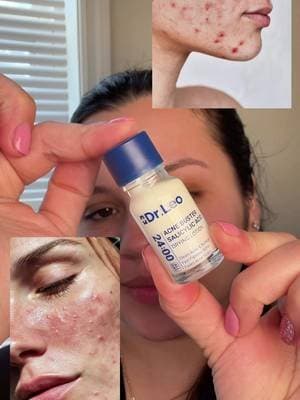 Dr. Leo Drying Lotion Plus ✨ Tratamiento puntual para ayudar a secar granitos y limpiar los poros @Dr.Leo-USA #tiktokshopcreatorpicks #valentinesday #acné #cuidadodelapielcoreano drleodryinglotionplus ácidosalicílico